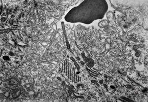 F,1y. | plexus papilloma F,1y. | plexus papilloma